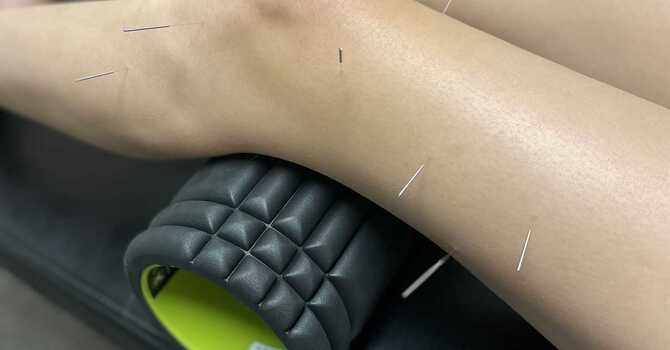 Acupuncture