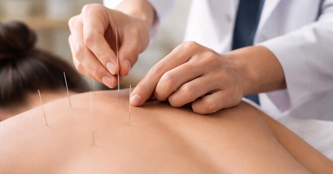 Acupuncture