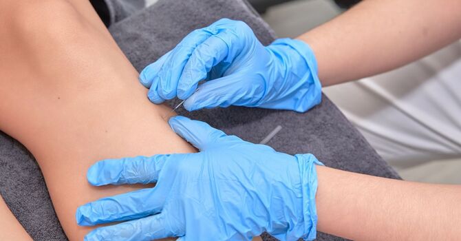 Does Dry Needling Help Sciatica?
