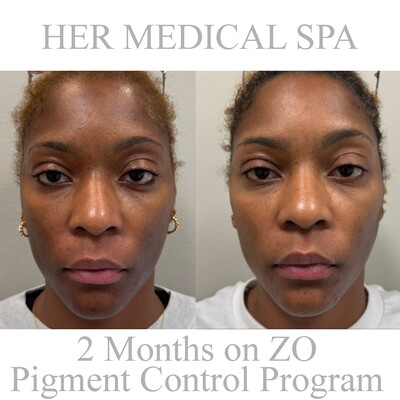 photo of before and after zo pigment control prgram