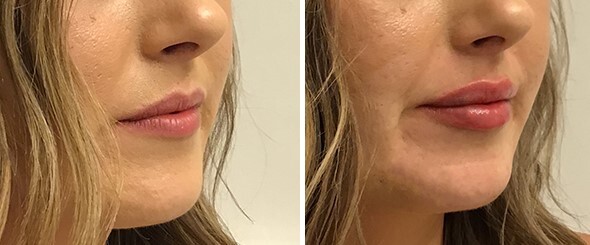 tailored to you-lip filler-filler-fuller lips-big lips-clinic-clinic near me-mitchell sd clinic-medical aesthetics1