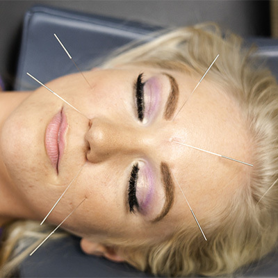 Acupuncture