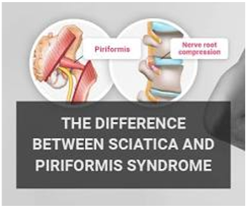 Piriformis and sciatica
