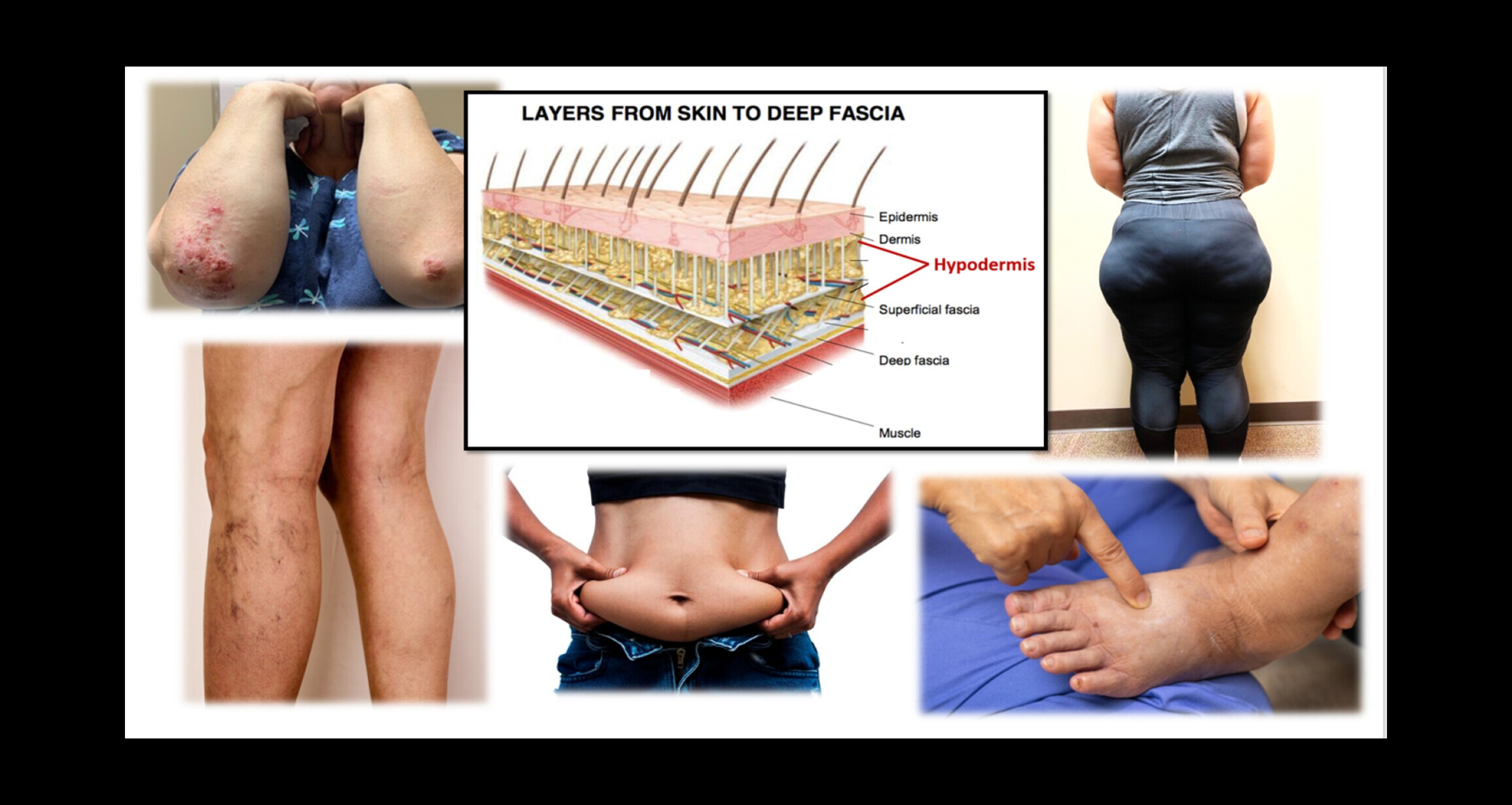 cupping - Edited