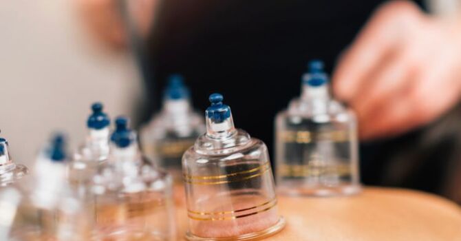 What Are the Benefits of Cupping Therapy? What Patients in Wilton Manors Should Know