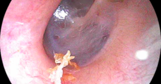 Can Ear Wax Cause Hearing Loss?