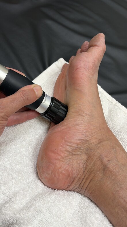 Shockwave treatment to the Plantar Fascia