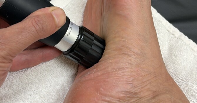 Treating Plantar Fascitis using Radial Shockwave, Fascial Scraping and Kineology Taping