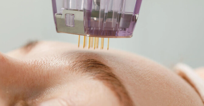 Microneedling