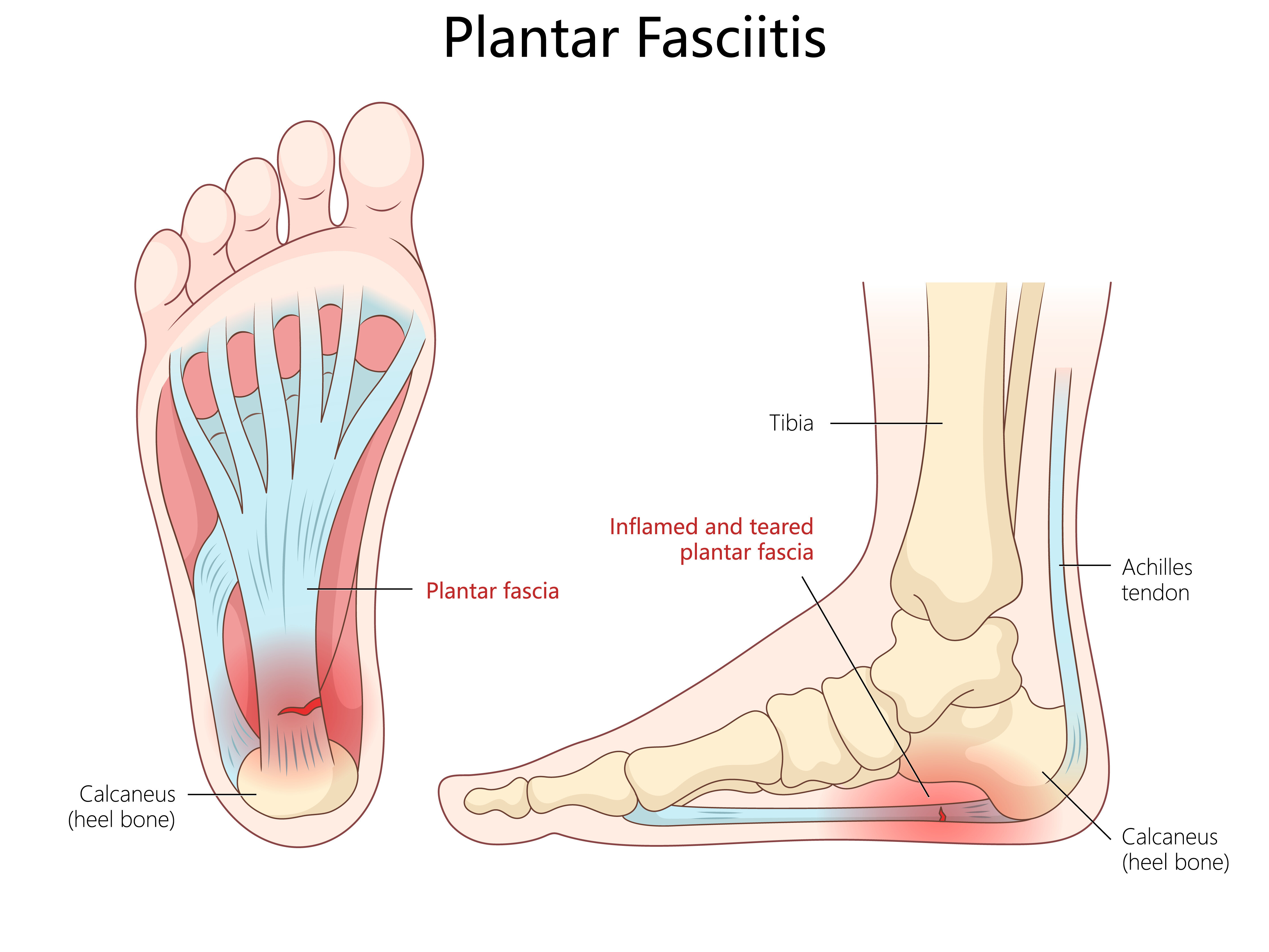 anatomical diagram: plantar fasciitis