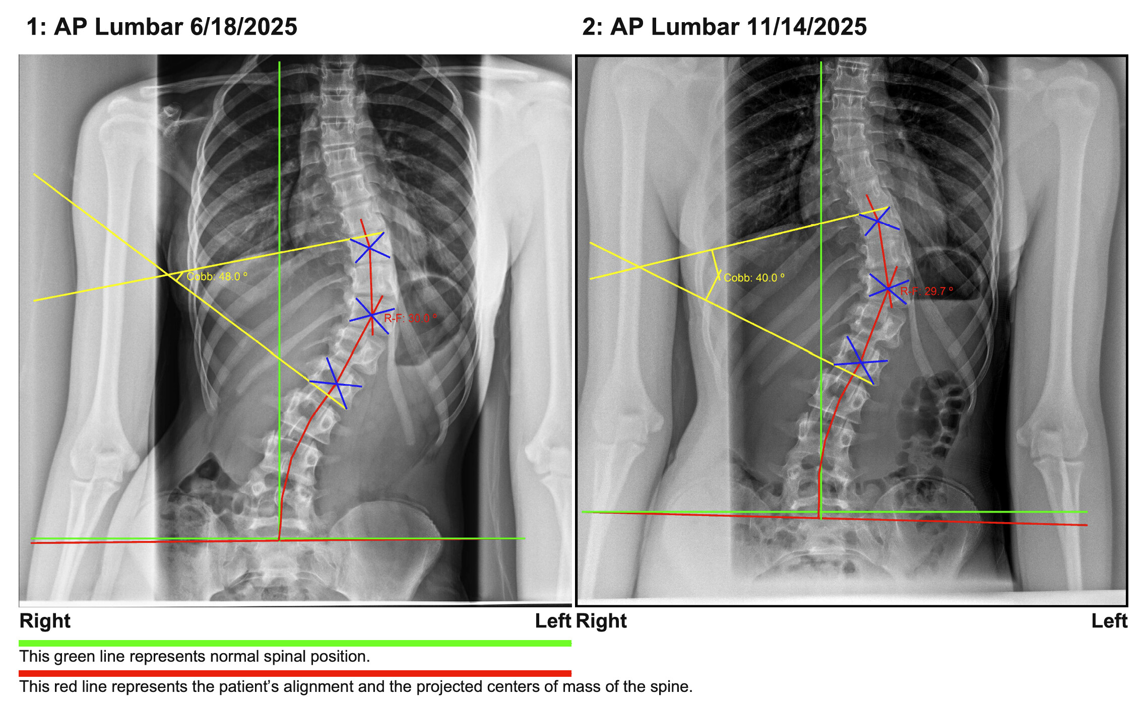 AB scoliosis