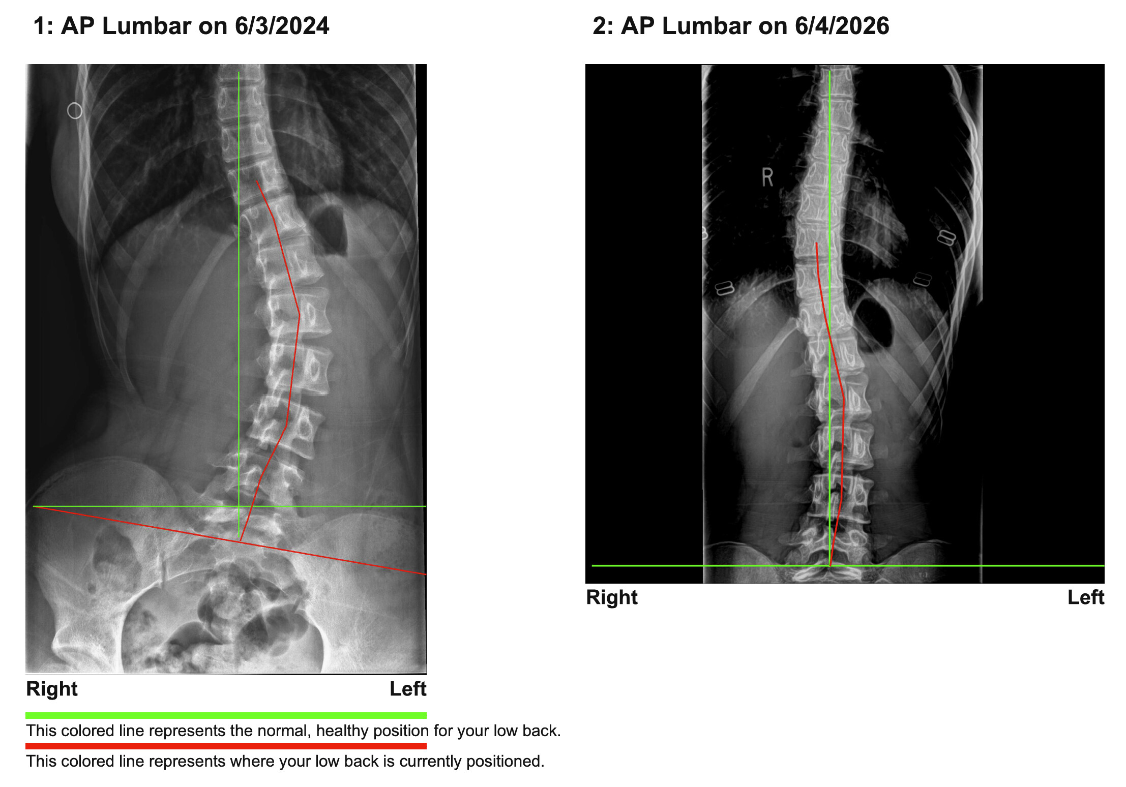 an scoliosis
