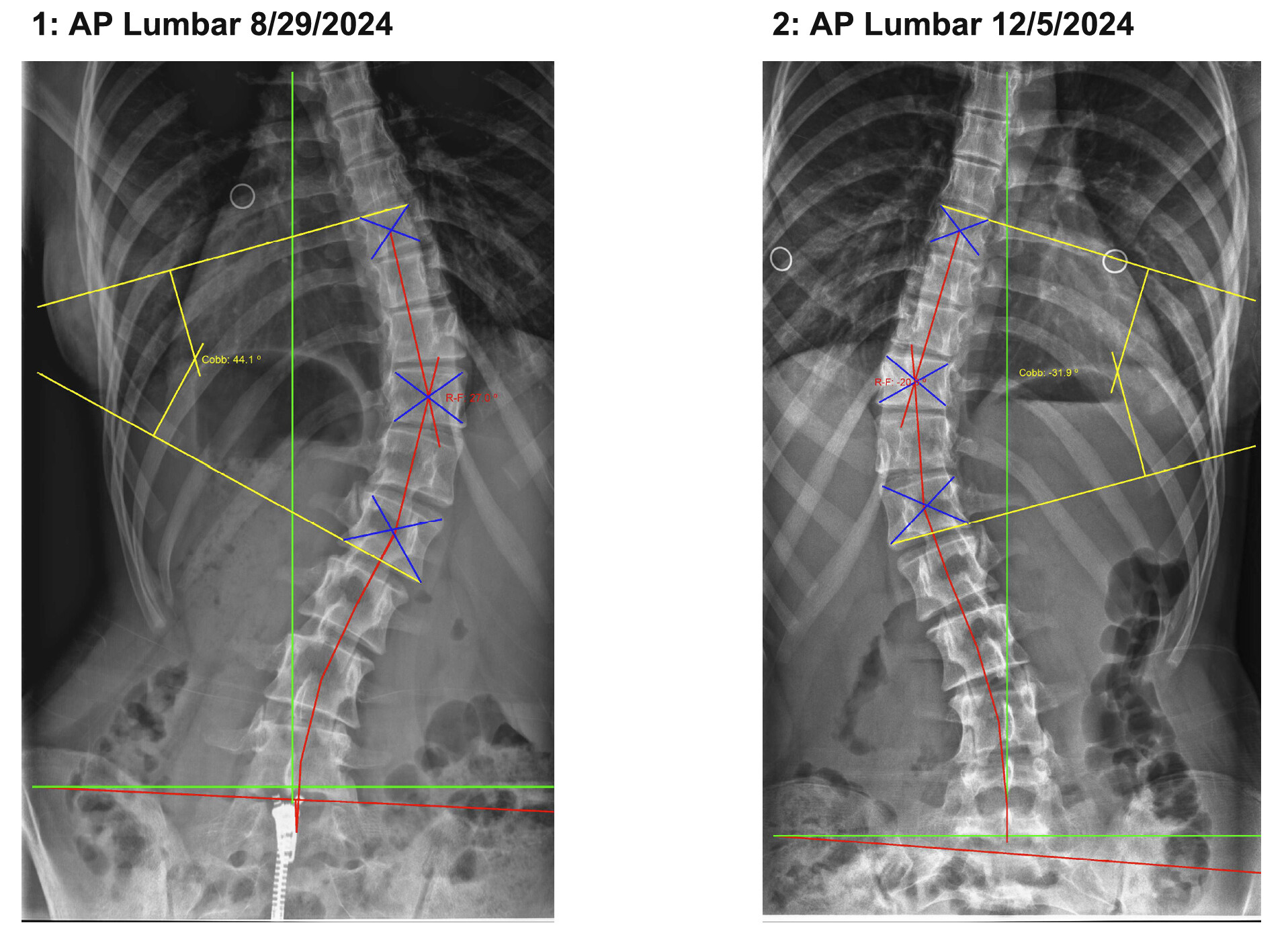 mhick scoliosis
