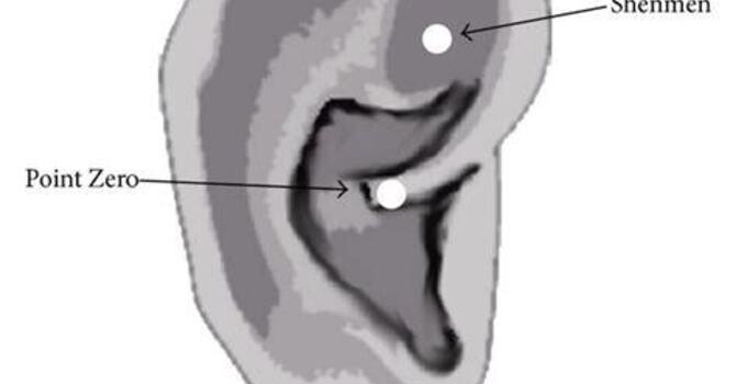 Donation Ear Acupuncture - June