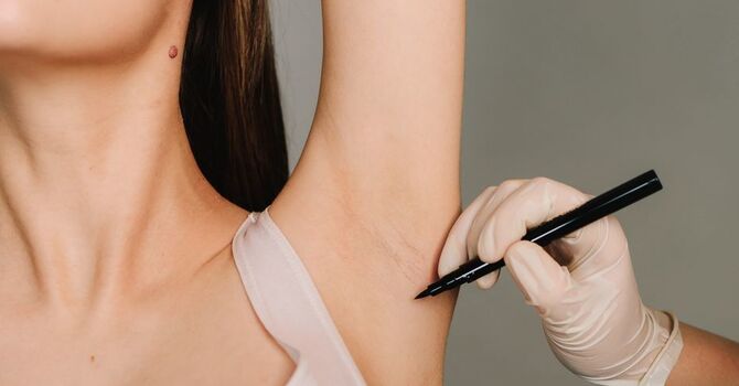 Hyperhidrosis