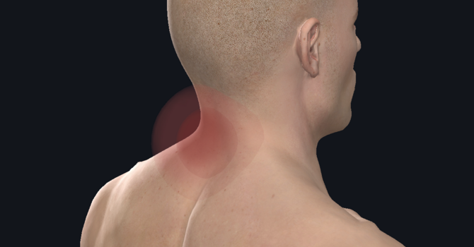 Cervical Whiplash