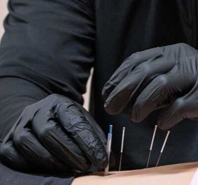 Dry Needling