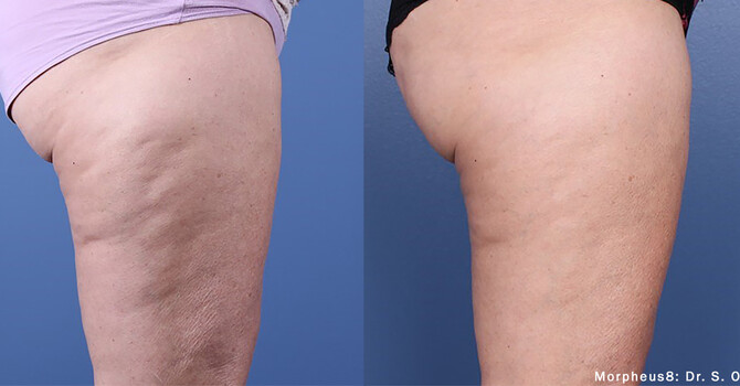 Skin Tightening