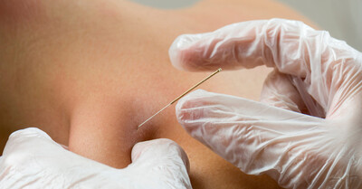 Intramuscular stimulation (IMS) dry needling performed by a physiotherapist at Great North Physiotherapy in St. Catharines to treat muscle pain and dysfunction.