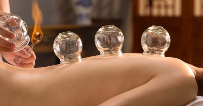 Fire Cupping