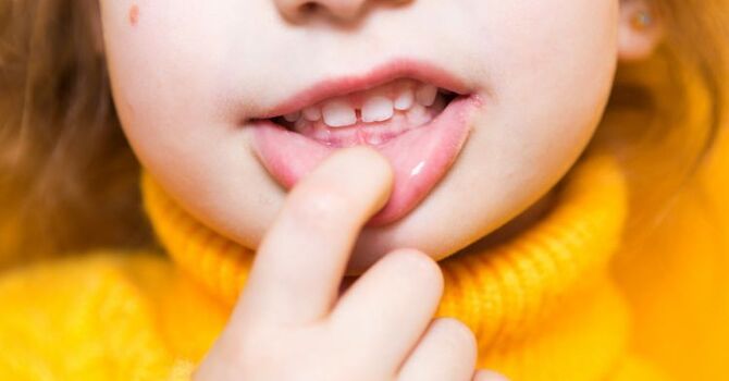 Can Myofunctional Therapy Help Correct an Overbite?