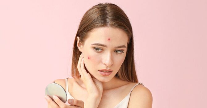 Acne Treatment