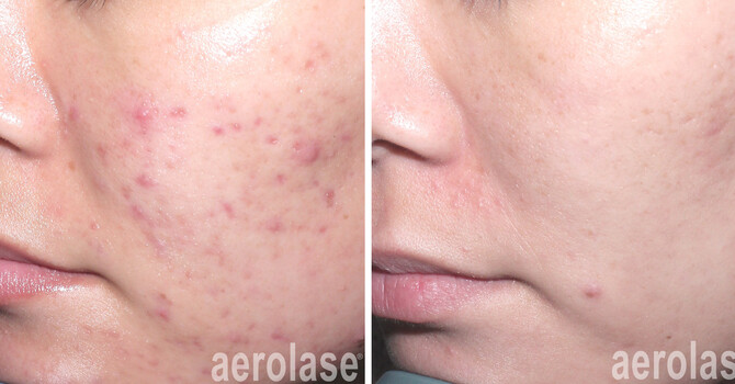 Aerolase Neo Clear