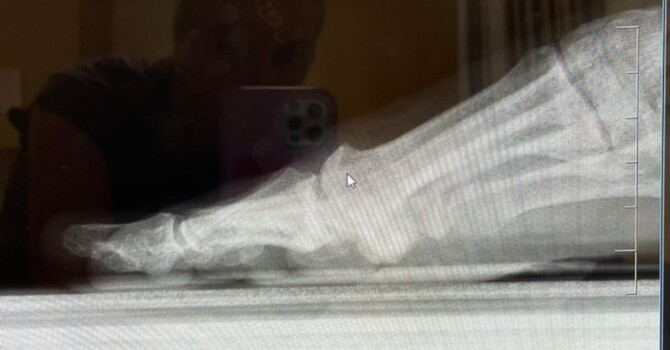 When the Big Toe Says “Enough”: Understanding Osteoarthritis in Dancers