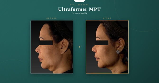 The Lift Lab — An Exclusive Ultraformer MPT Launch