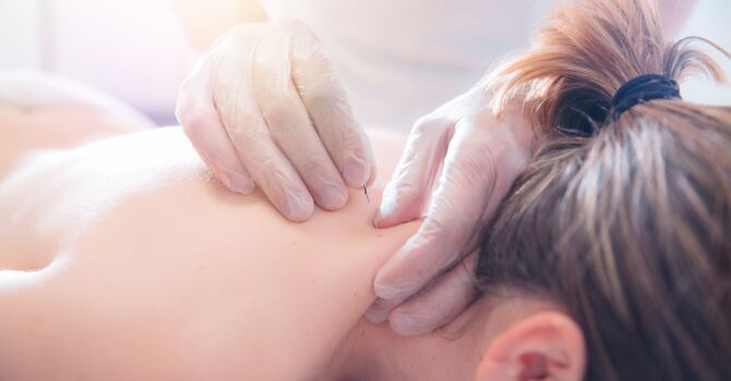 How Acupuncture Can Help With Headaches and Migraines image