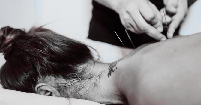 ACUPUNCTURE AT (se)® image