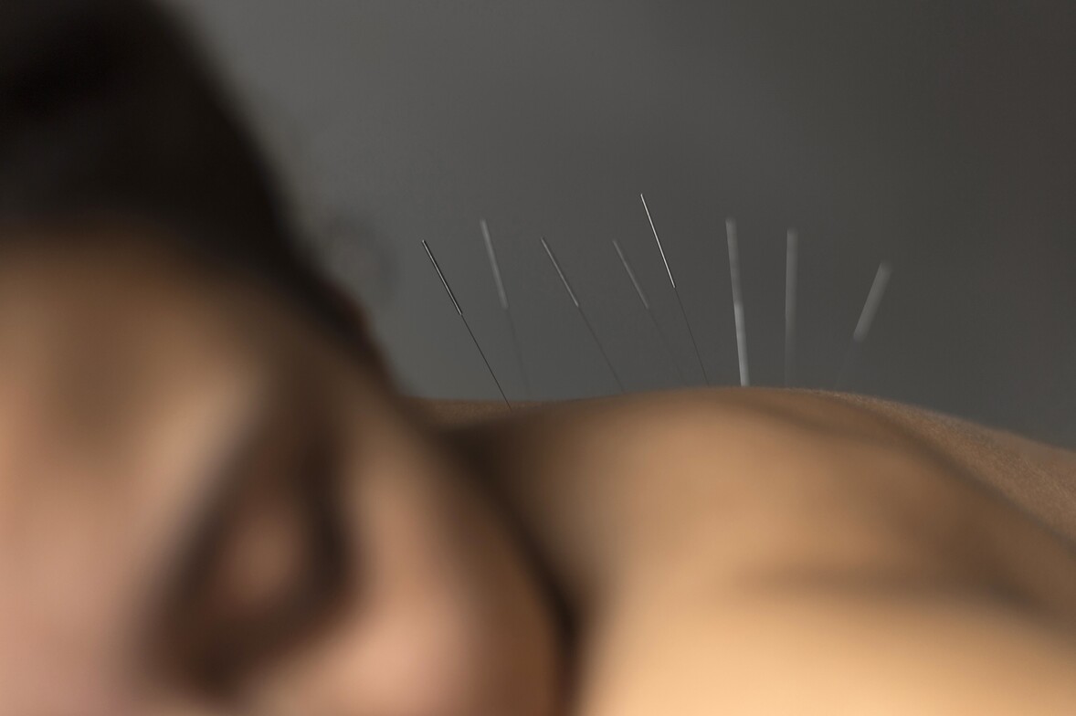 acupuncture, boone acupuncture 