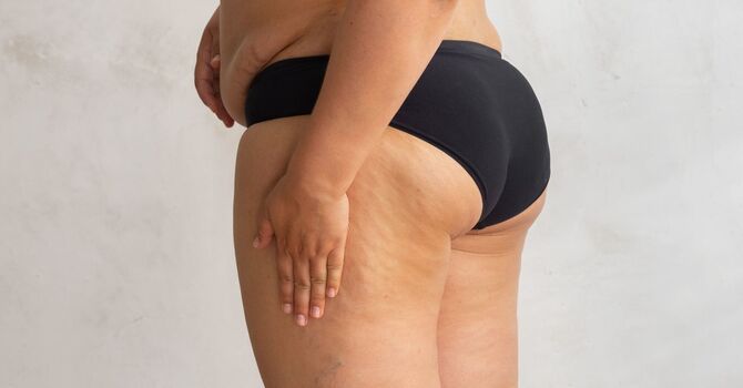Cellulite
