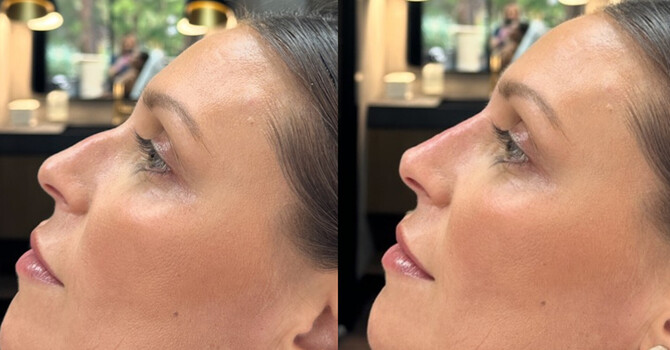 Non-Surgical Nose Correction