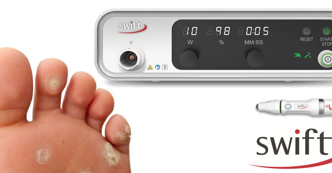 Swift Verruca Treatment in Kent