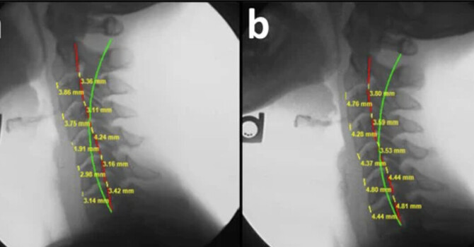 Spine Structure- Pain and Accelerated Degeneration image