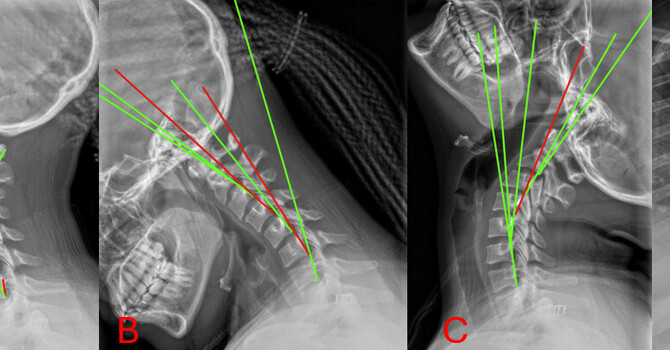 Does Scoliosis Affect Injury Risk During a Car Accident? Biomechanical Considerations image