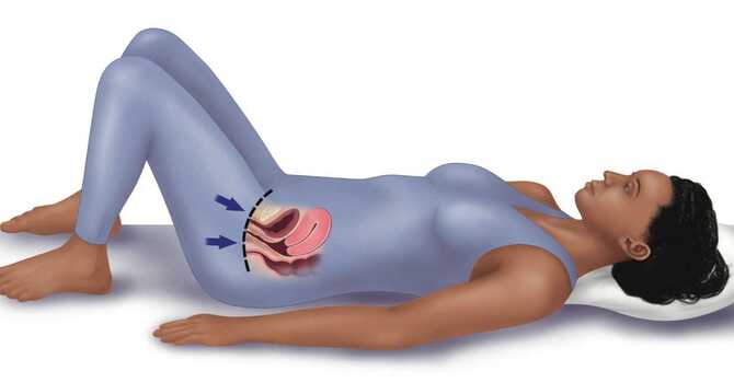 Urinary Incontinence 