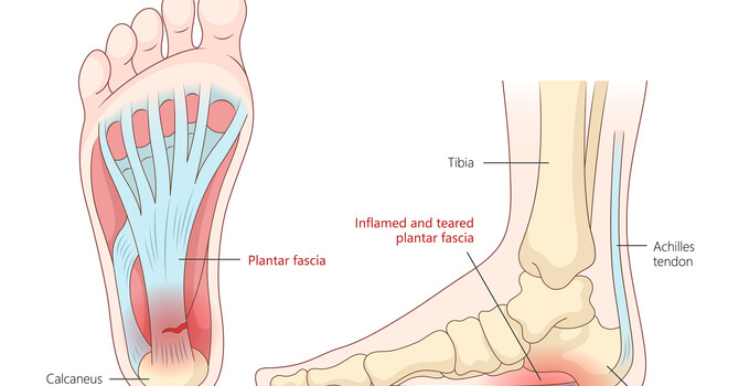 Plantar Fasciitis: Causes, Symptoms, and How Chiropractic Care Can Help  image