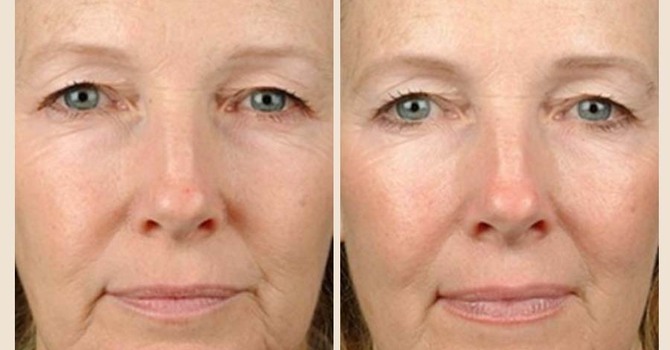 Non-Surgical Facelift in Edmonton | Everesse RF + Ultraformer MPT