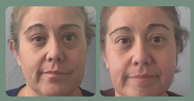 Restoring Confidence and Function: How Cosmetic Acupuncture Supports Facial Paralysis RecoveryAt 