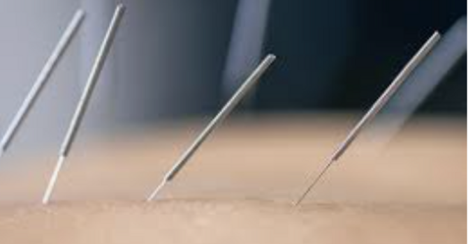 What Is Dry Needling and How Does It Help? image