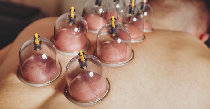 Cupping Therapy Benefits for Chronic Pain Relief and Healing