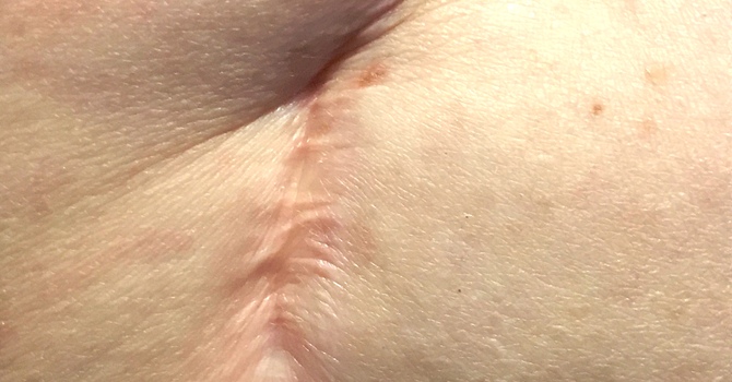 Scar Tissue Therapy