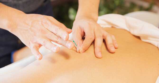 Benefits of Dry Needling image