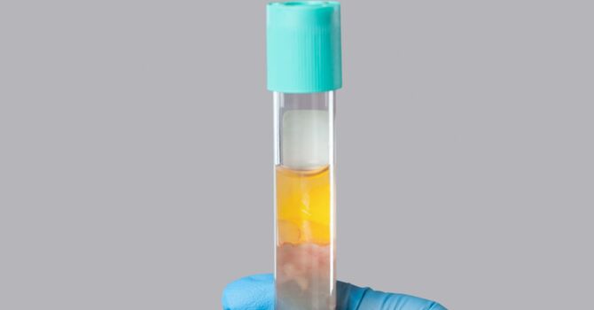 High Density PRP for Joint Pain image