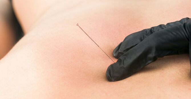 Dry Needling