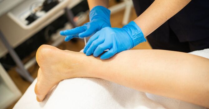 Verrucae Needling