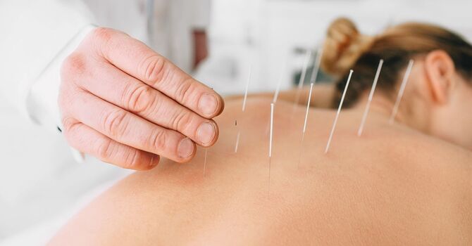 Acupuncture for Headaches: How It Works and When It Helps Most