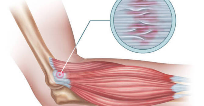 Adapter les tendons : exercices, charges et progression image
